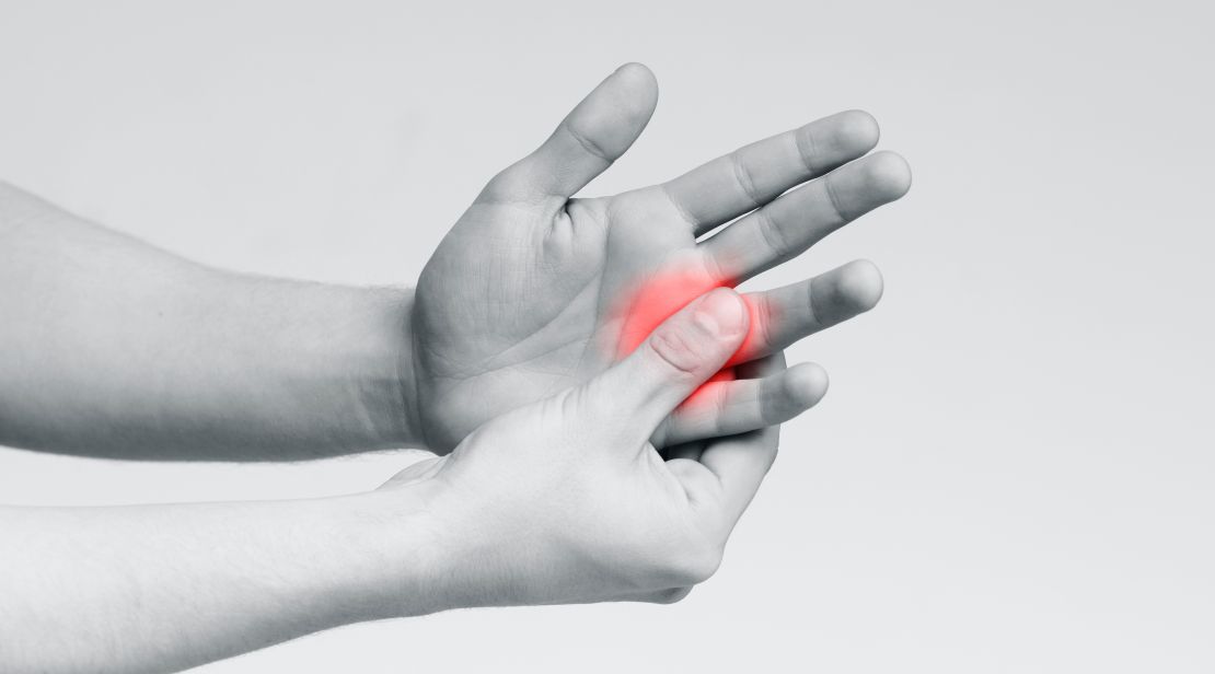 Stenosing Tenosynovitis (Trigger finger)